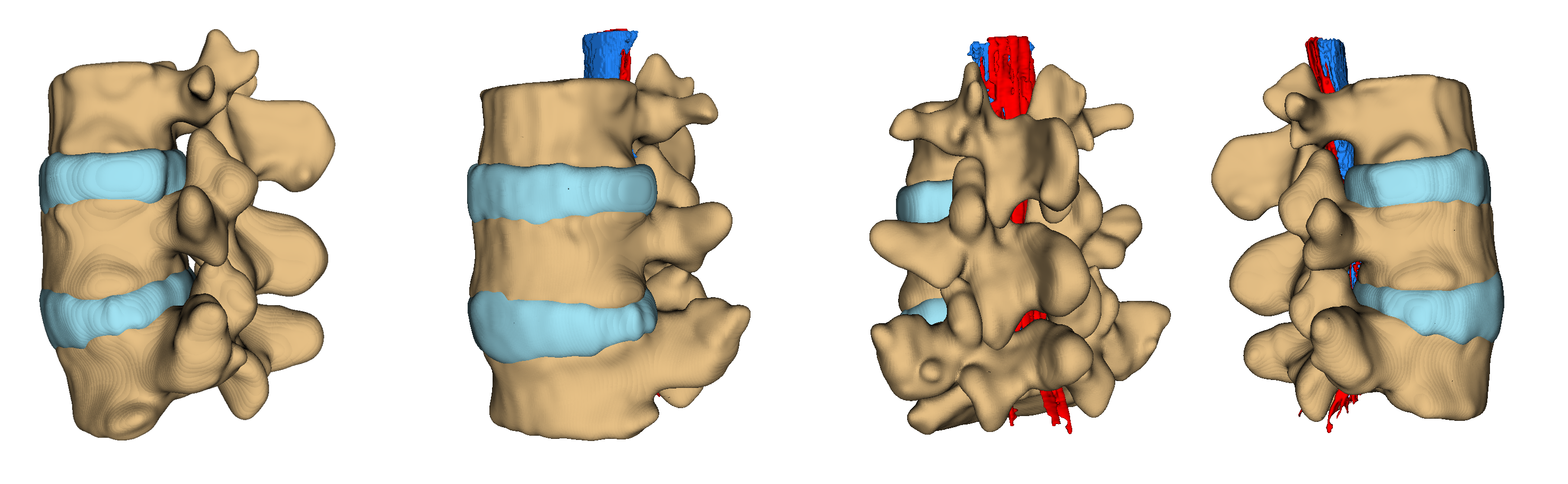 The cause of back pain is the pressure of the herniated disc onto the spinal nerves. This Slicer rendering shows an herniated disc pushing the canal for the cerebro-spinal fluid (CSF).