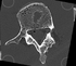 RegLib 43:3D models of human vertebrae obtained from CT