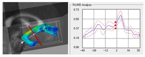 White matter diffusion properties along fiber tract: Left: Uncinate fasiculus with coordinate origin plane, Right: FA mean and standard deviation as function of arc-length, left to right.