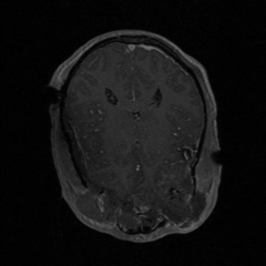 Multimodality Image Registration For TBI - NAMIC Wiki