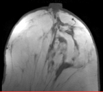 this is the moving image, to be registered with the reference above: PostRx Breast MRI with tumor largely absent