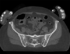 RegLib 44: Visible Human Pelvis CT