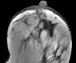 this is the fixed reference image: PreRx Breast MRI with large tumor mass