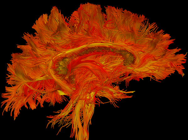 Filtered tractography.png
