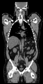 this is the fixed CT image. All images are aligned into this space