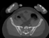 RegLib 44:Visible Human Pelvis CT